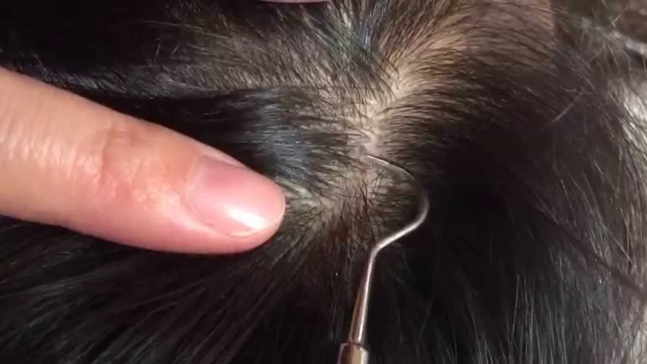 皮むけを早く治すには？日焼け後の肌再生とおすすめ市販薬 薬剤師執筆– EPARKくすりの窓口コラムヘルスケア情報