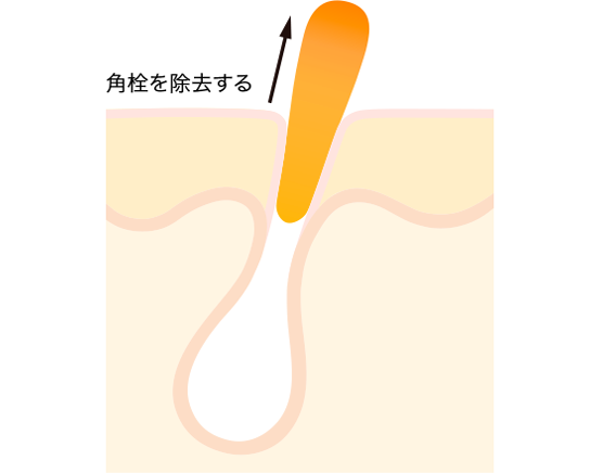 あごの角栓をなくしたい！良くない行動からケア方法まで解説 メンズスキンケアに答えを「DISM」