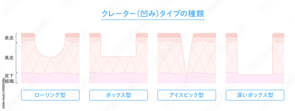 ニキビの芯の正体は何？正しい出し方とは？美容皮膚科タカミクリニック 東京 表参道