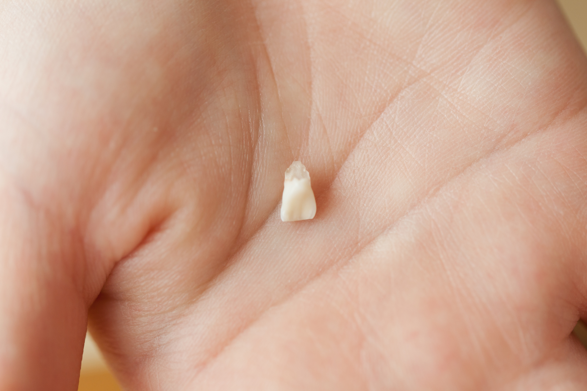 2015年 10月 歯の根っこが溶ける！？ ―歯根吸収―