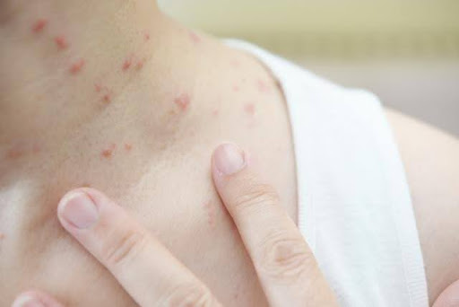 ダニ刺されの特徴について解説 症状・薬・治し方やダニ対策ひまわり医院 内科・皮膚科