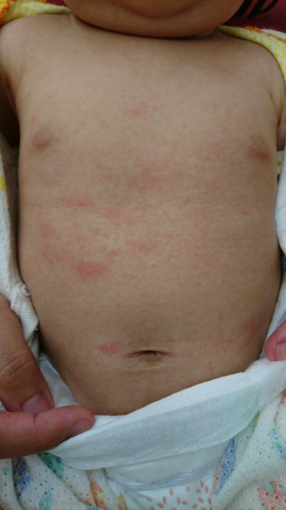 助産師監修 赤ちゃんのあせも対策完全ガイド原因・ケア・病院に行く目安まで- キッズライン