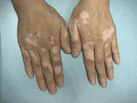 約10年間、白斑症状に悩んでいた１人の女の子の人生に光を与えたメディカルメイクアップ※1特定非営利活動法人メディカルメイクアップアソシエーションのプレスリリース