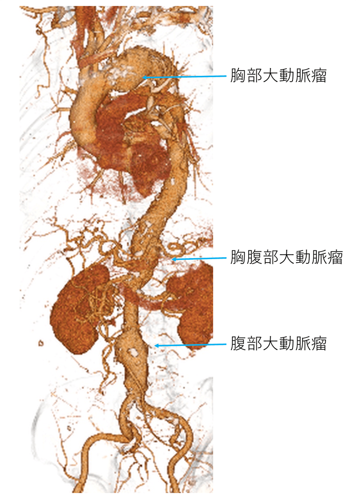 大動脈瘤 大動脈解離 - 聖路加国際病院 心血管センタ