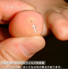 診断結果：足底疣贅 そくていゆうぜい長崎で皮膚のトラブル・美容は篠原皮膚科クリニック