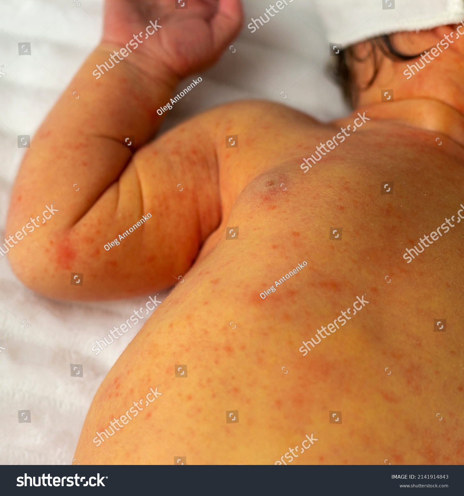 新生児黄疸 おうだん とは？ 原因や症状、いつまで続くかを詳しく解説ママパーク