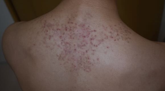 胸部から激しい皮膚炎が拡大していた男性。痒みと痛み、色素沈着も改善 症例：53アトピー脱ステロイド専門入院自然療法『ナチュラルクリニック21』