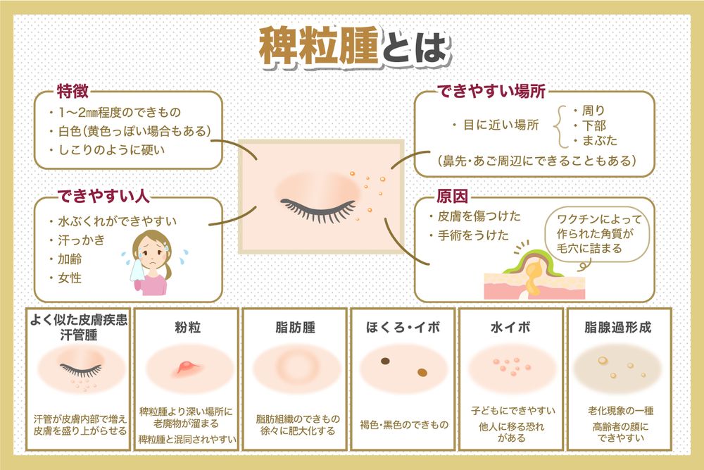 稗粒腫 はいりゅうしゅ 目の周りや顔にできる白いポツポツ - 東京・大阪の美容皮膚科ならFLALU フラルクリニック