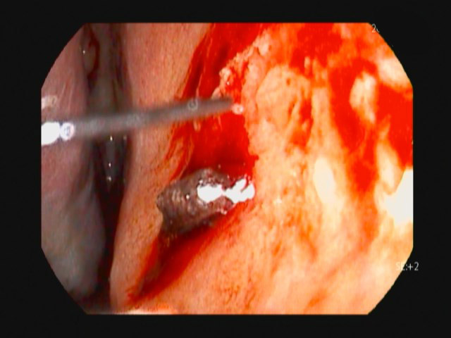 鼻茸とは・鼻ポリープの原因と治療方法大阪の北東大阪耳鼻咽喉科 鼻・副鼻腔手術クリニック
