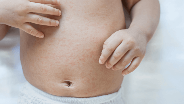 生後５ヶ月 背中に湿疹７歳発達凸凹・３歳息子育てブログ☆