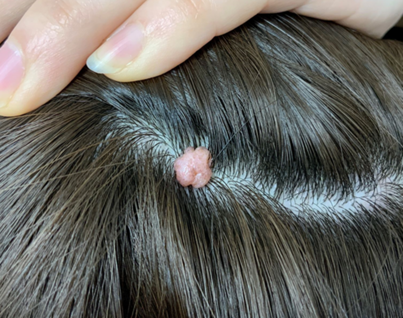 頭のニキビでハゲる事がある？ 頭皮に現れる「できもの」とその予防法名古屋中央クリニックAGA・薄毛治療どっとこむ 新着情報