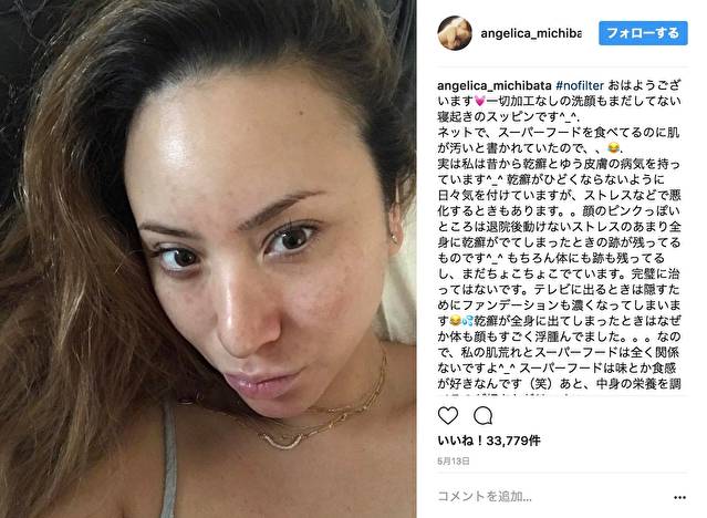 尋常性乾癬大山皮ふ科 形成外科