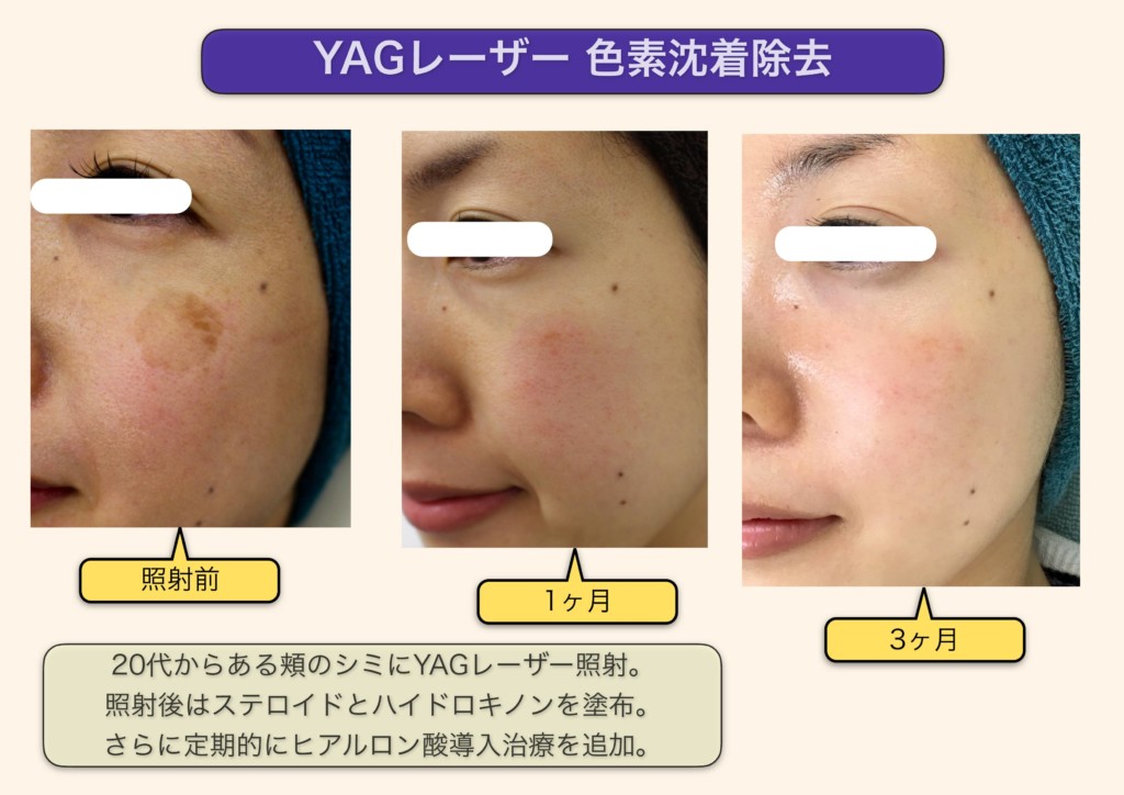 美容医療を受けるなら知っておきたい基礎知識⑥なんでレーザーでシミが取れるの？はじめての美容医療ジェイメック