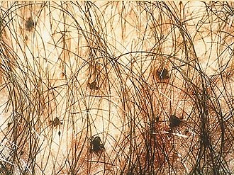 ケジラミ症の解説 症状や感染経路・検査や治療について│STD研究所