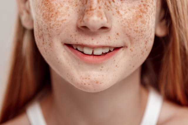 5分間シミ取り放題 年齢を感じさせるシミを改善したい 60代男性 症例No.29Y0000618樹のひかり形成外科・皮ふ科 奈良 美容整形・美容皮膚科クリニック