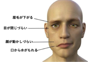顔面神経麻痺 -公式 目黒まぶたのクリニック目黒駅徒歩4分・保険診療眼瞼下垂・逆さまつ毛