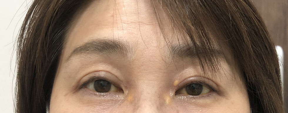 札幌医科大学 形成外科まぶたの異常まぶたの腫瘍 できもの