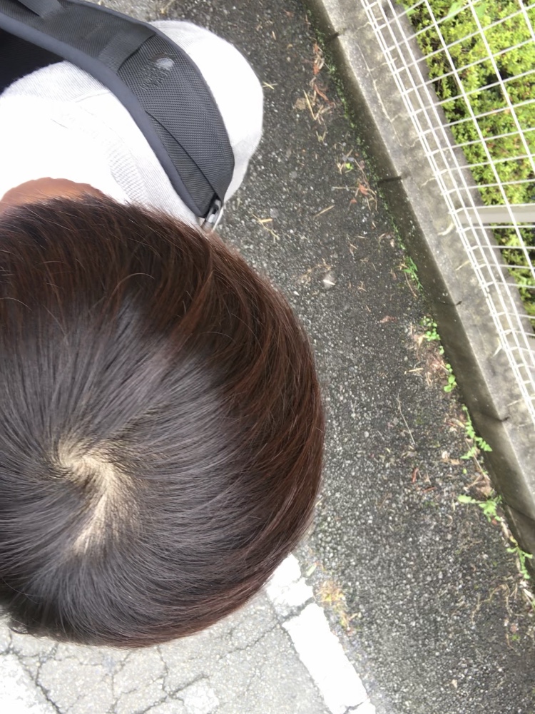 写真付き つむじはげの見分け方＆原因を解説！初期から重度まで6つの対策もご紹介The Style Dictionary