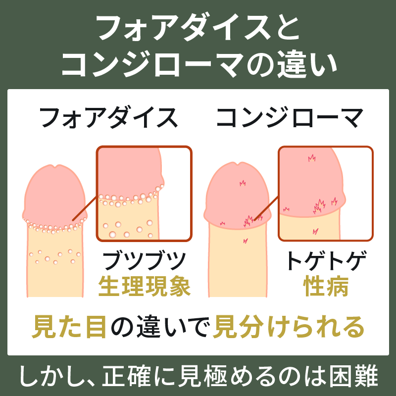 尖圭コンジローマは性病の一種です！〜症状や治療法についてイラストで解説〜泌尿器科バウムクリニック川口駅近くの泌尿器科