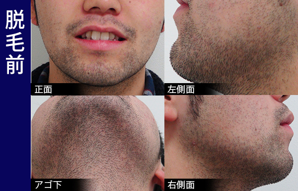 心斎橋でヒゲ脱毛1年通い放題 月額3,300円 はZEROヒゲ脱毛 ZERO 心斎橋