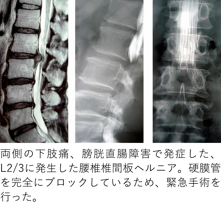椎間板変性 ヘルニア -こまごめ腰痛治療室 腰痛専門の当院へお任せ下さい