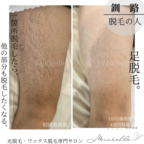 医師監修医療脱毛とエステ脱毛の違いは？ 効果・期間・費用・痛みを比較脱毛・ニキビ治療・ダイエットのイデア美容皮膚科クリニック 柏・船橋・錦糸町