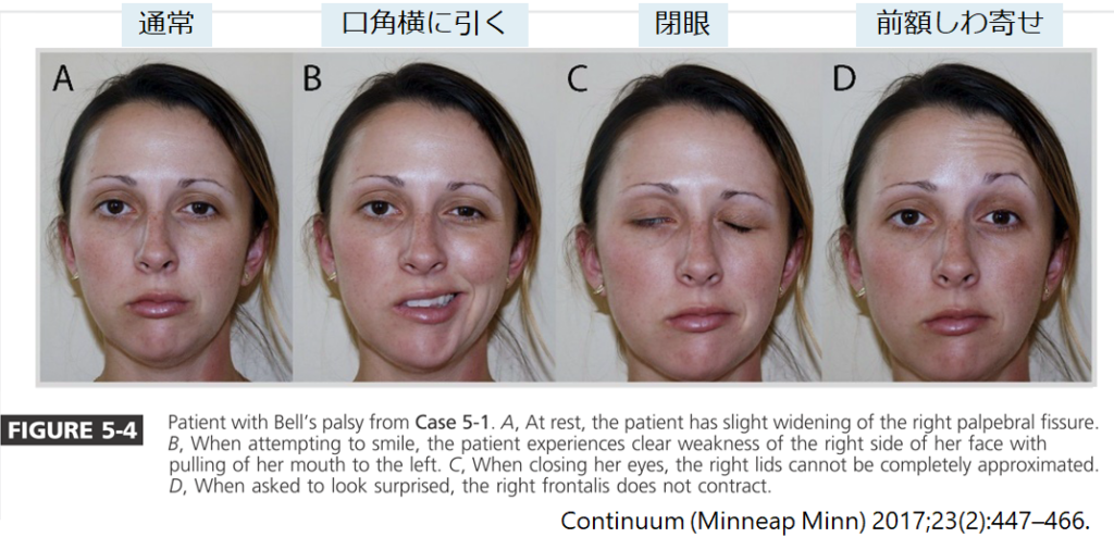 図解・決定版 脳梗塞の予防がよくわかる最新知識内山 真一郎医学・薬学KindleストアAmazon