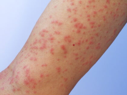 かゆみや症状で判断できる!? 蚊とダニの刺され方の違い - ウェザーニュース