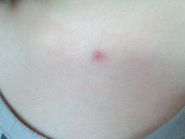 背中・胸のなかなか治らないニキビでお困りの方は福岡早良区の星の原クリニックにどうぞ