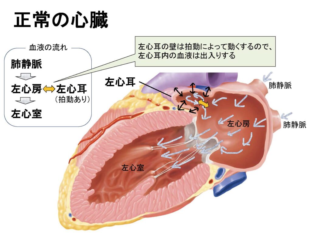 胎児期に診断し，無治療で経過観察できている先天性右心耳瘤の一例