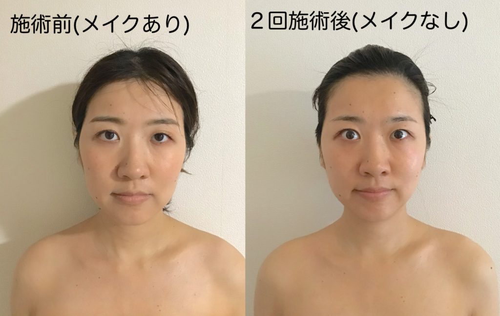 顔のこわばり飛騨高山バランス整体・こせ接骨院