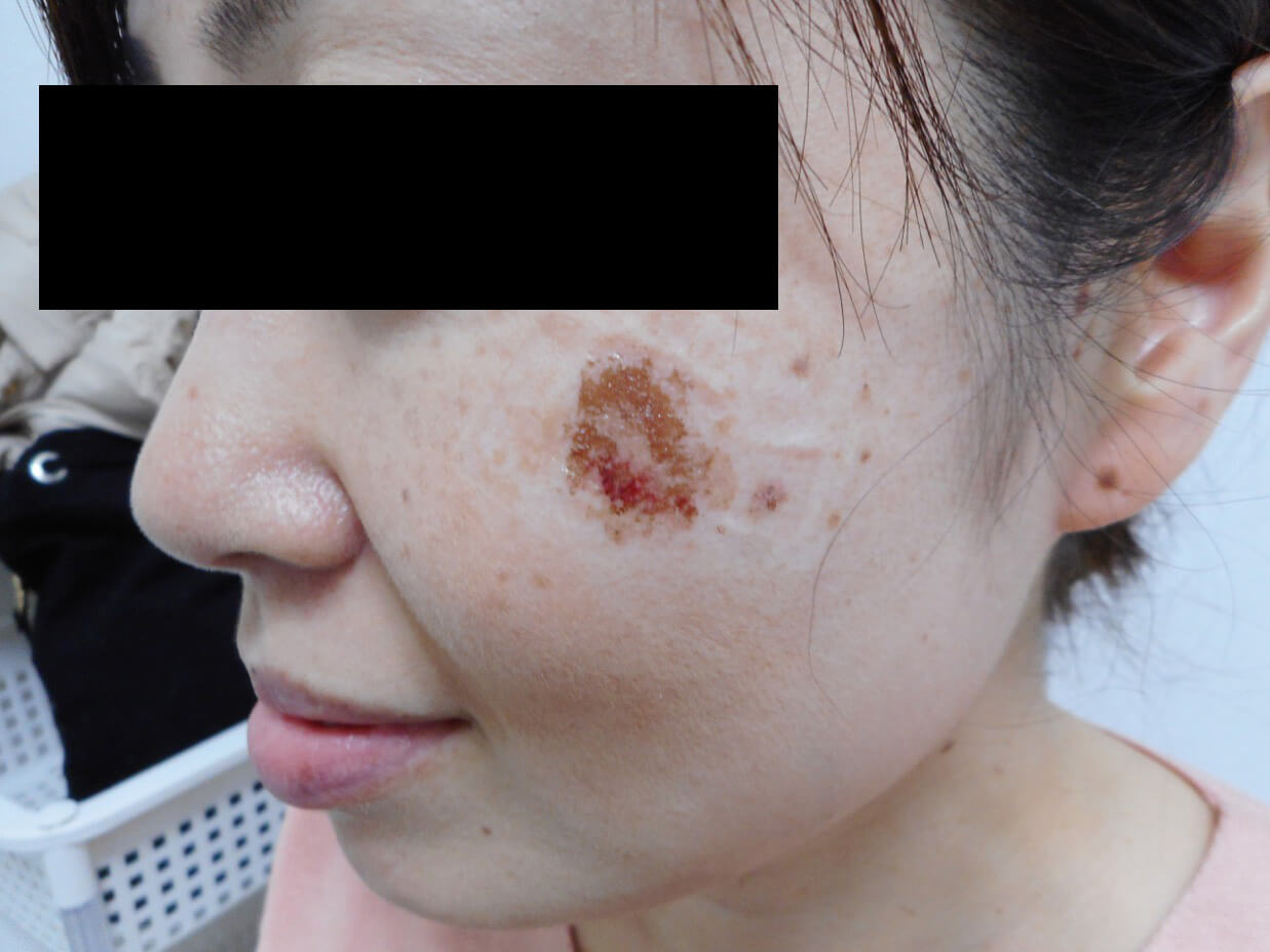 シミ取りレーザーの失敗例 - 東京・大阪の美容皮膚科ならFLALU フラルクリニック