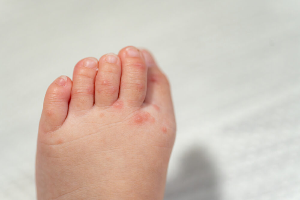 ヘルパンギーナ - つつみこどもクリニック