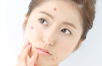 第2類医薬品 ラウマーアクネクリーム 5個セットアウトレット塗る 薬 治療薬 治療 ニキビ薬 大人ニキビ にきび 吹き出物 吹き出物治療薬市販薬 おでき 毛穴 肌荒れ 顔 頬 顎 あご 首 デコルテ 顎ニキビ フェイスライン 塗り薬 べたつかない 抗炎症 市販バンキョードラッグ