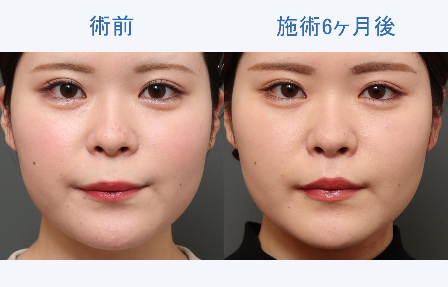 高校生の究極の二重整形‼️二重手術であなたの魅力を最大限に引き出します9beautyclinicりく先生池田陸二重整形二重埋没二重手術末広二重平行二重目頭切開ハム目埋没法アイプチアイプチ卒業アイプチかぶれ銀座美容外科まぶたの脂肪