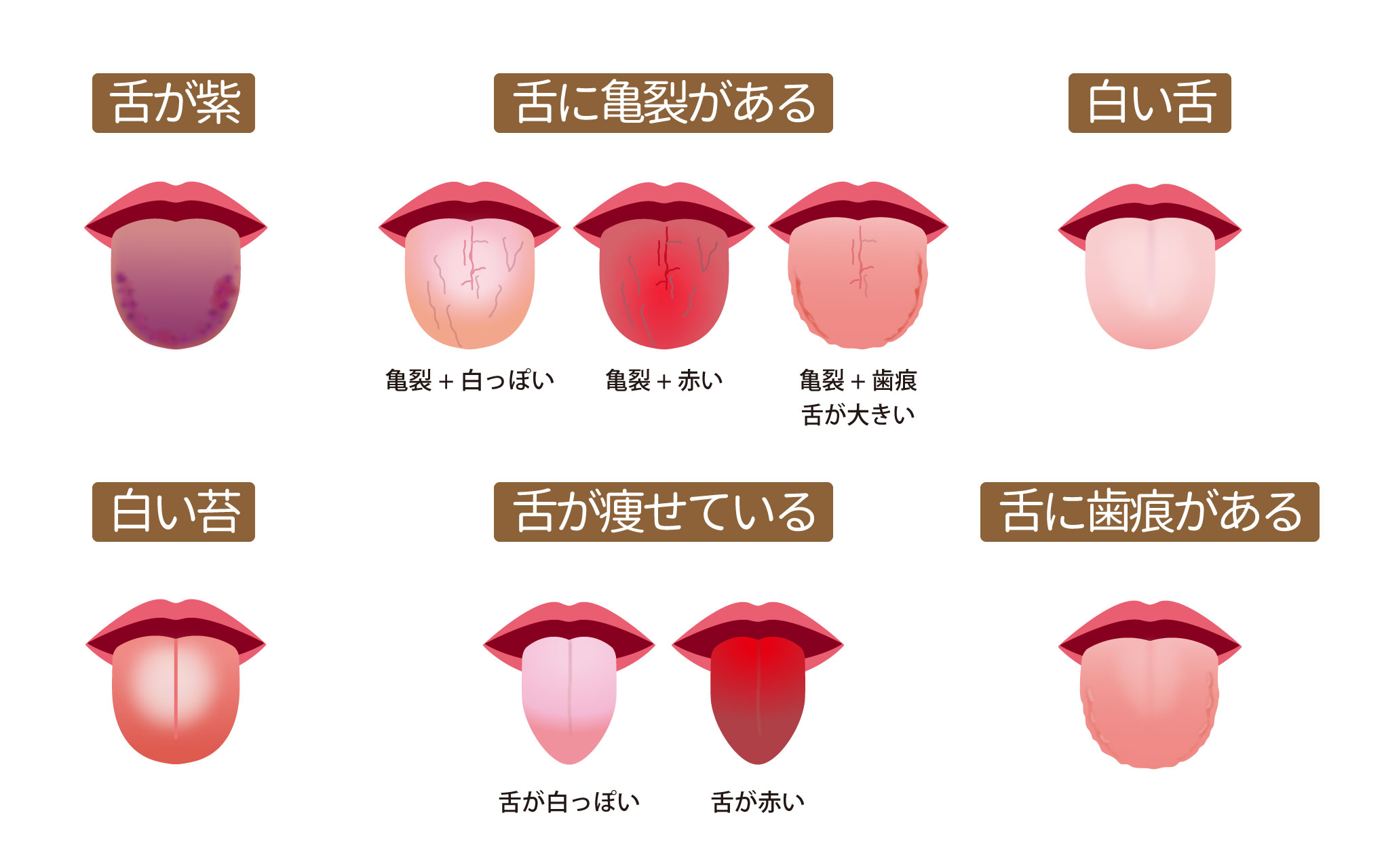 舌診～毎日鏡の前で健康チェックをしたくなる舌の状態を解説 祥泉針灸整骨院