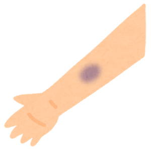 赤ちゃんや子供の青あざが消えない原因は？突然できた青あざやぶつけたときの青あざがどれくらいで治るのかを解説