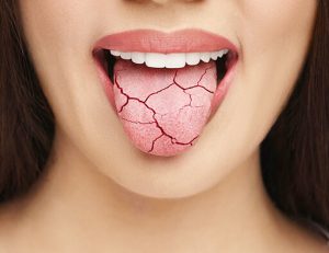 舌の表面に多くの深いシワ、溝が発生して舌が割れてしまったように見える状態を溝上舌と言います。 溝上舌はほとんど先天的なもので生まれつき舌にひび割れがみられる方は治療の必要がない場合が多いです。カンジタ症、ウイルスなどの感染、外傷、ビタミン不足、ドライ