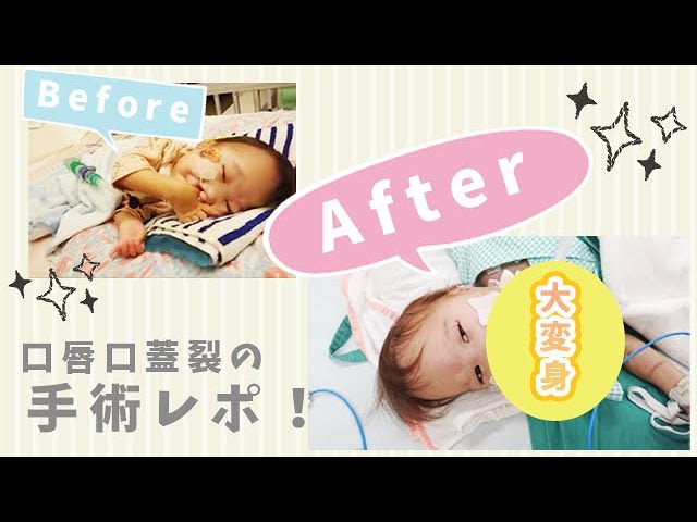 口唇口蓋裂神奈川県立こども医療センタ