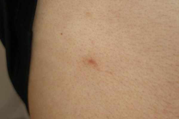 閲覧注意 ノミが家の中で大量発生！刺されたときの特徴と駆除アイテム紹介 - Photokoto