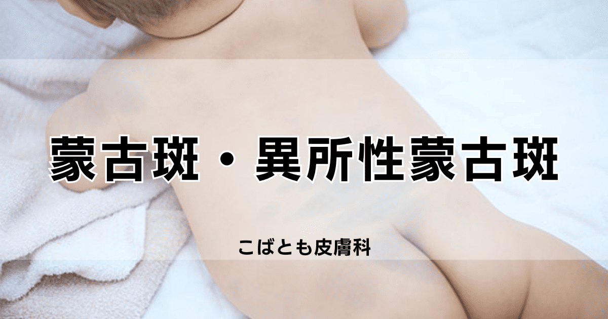 わが子の消えないアザは蒙古斑？診断の結果と治療内容 ベビーカレンダー