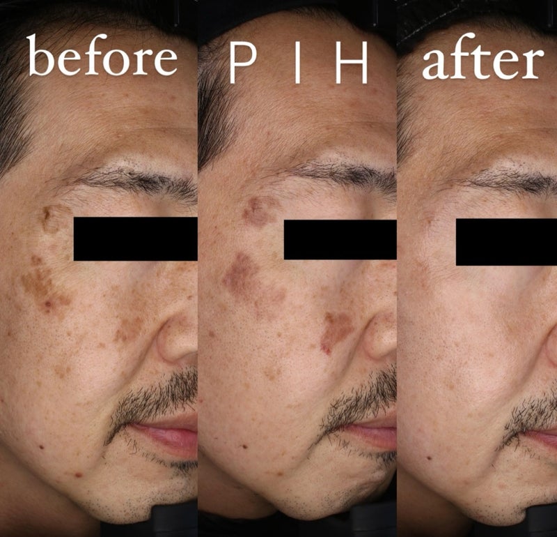 みき先生のシミ取りの経過ゆみ美容皮膚科クリニック