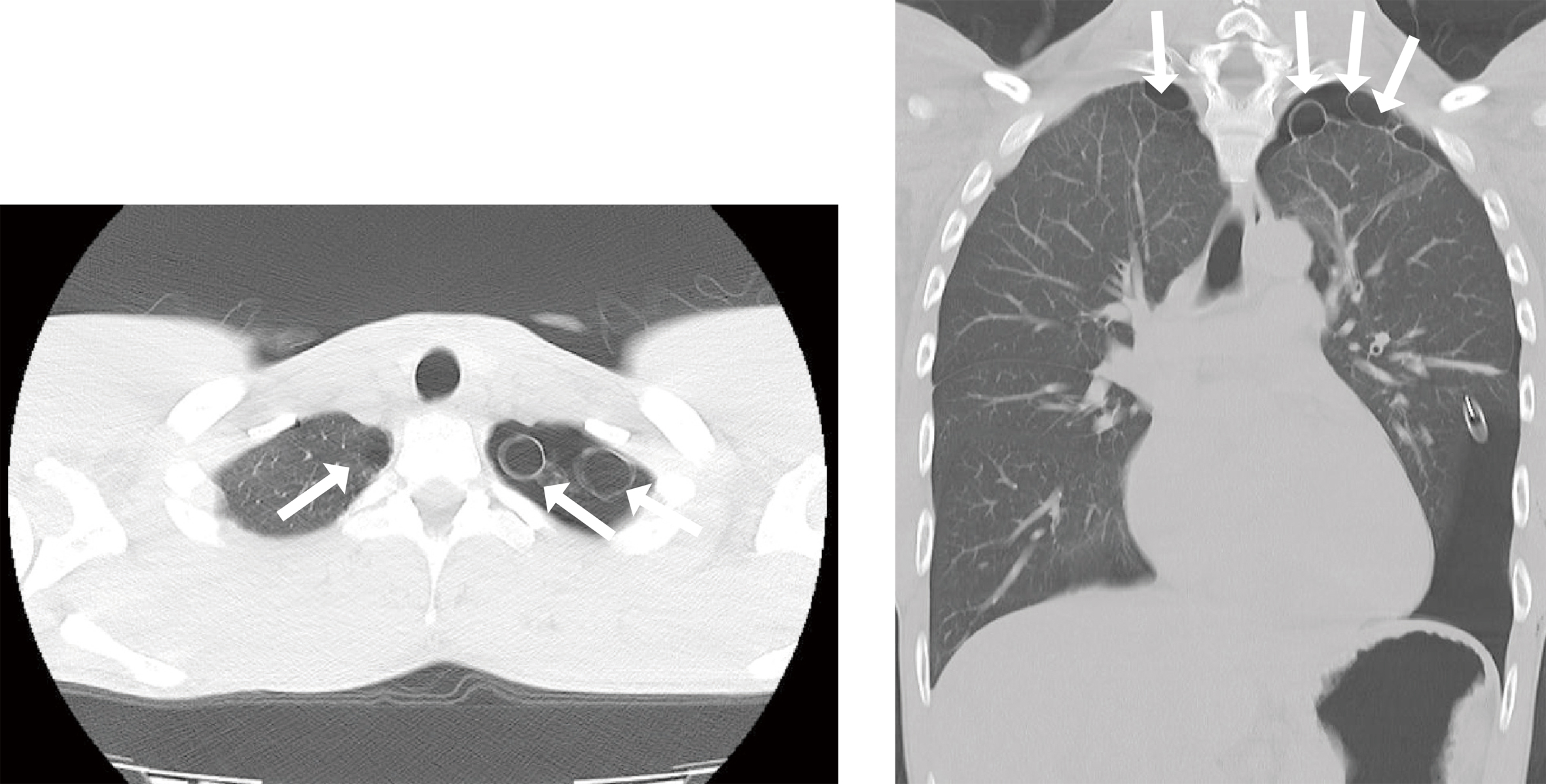無気肺 - Wikipedia