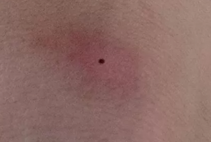 虫刺症 虫刺され- つくば・土浦鶴町皮膚科クリニック