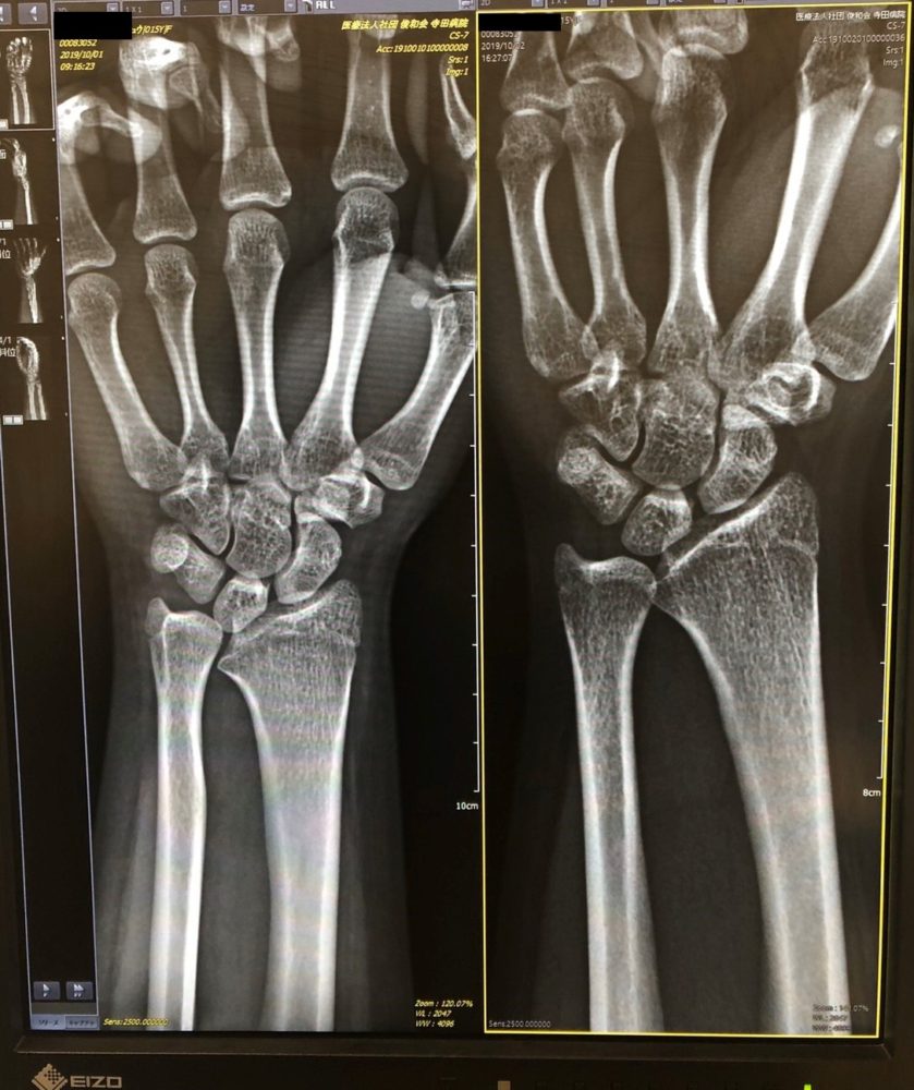 尺骨突き上げ症候群手の治療専門サイト