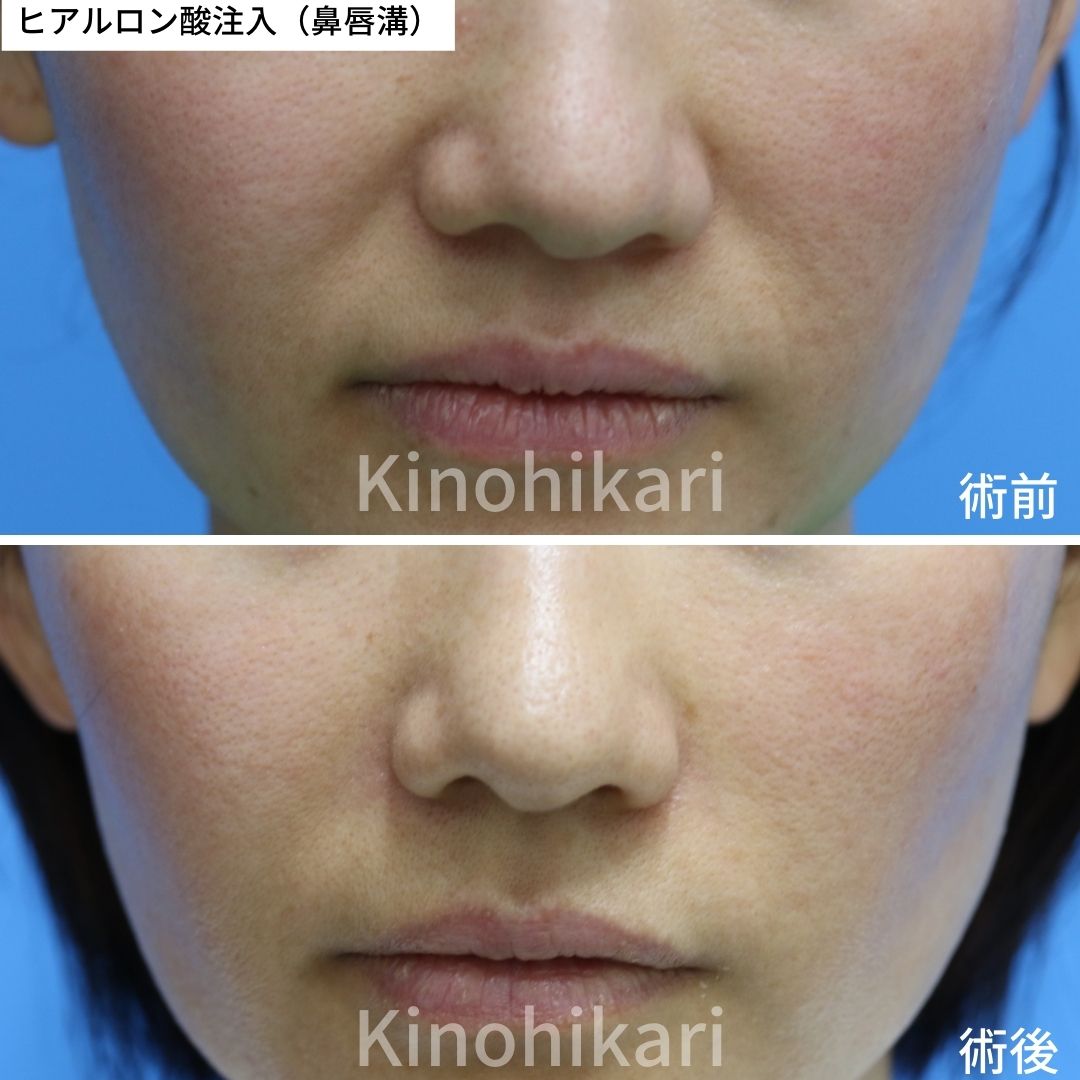 ボトックス注射 眉間のシワ、鼻根のシワNo.21130代女性の症例写真KOBE美容皮膚科福岡天神院