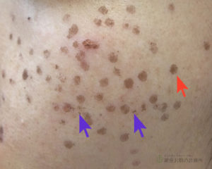 Qスイッチルビーレーザー シミ・あざ・刺青・タトゥー除去 美容皮膚科エルムクリニック