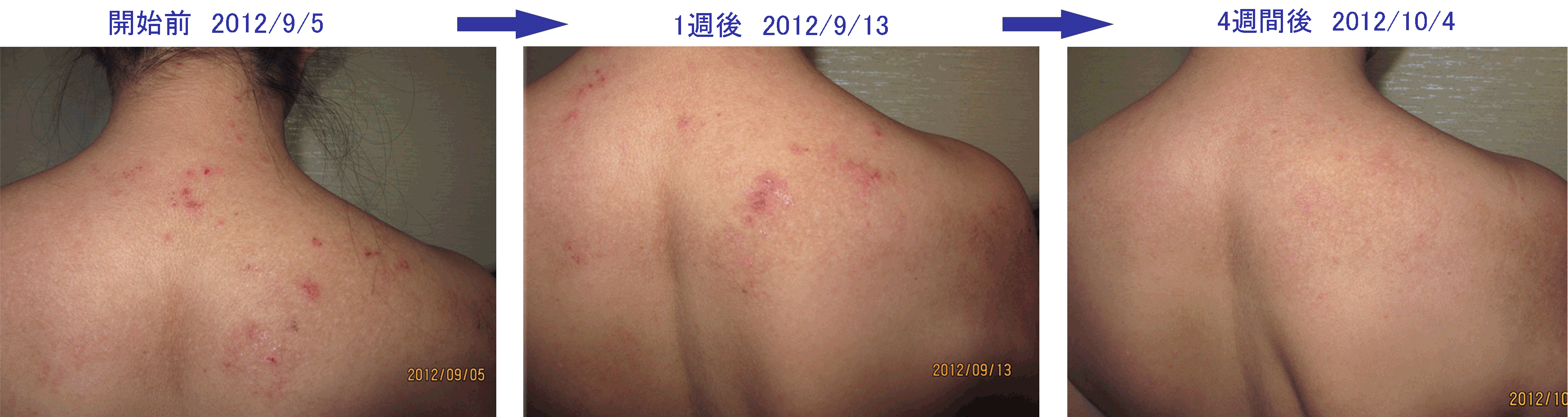 皮膚症状 - 相模原のはり灸院こうえい肩こり・腰痛・自律神経ケアと美容鍼