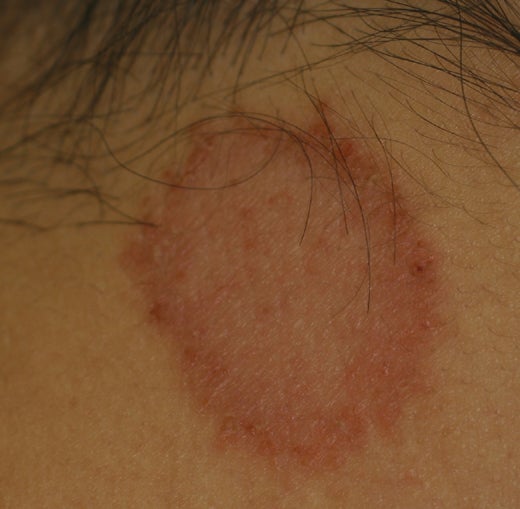 みずむし・たむし 白癬お肌のクリニック