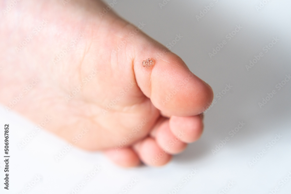 足底疣贅 - Wikipedia